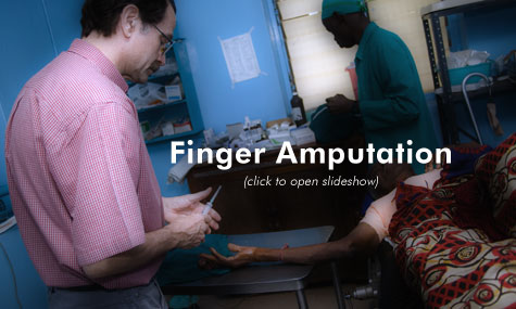 Finger Amputee