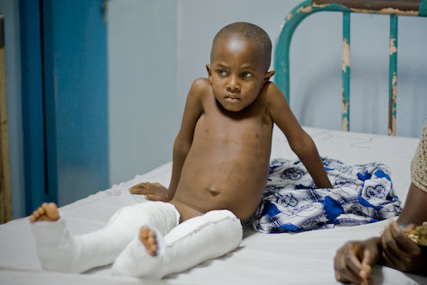 A boy recovers after corrective surgery for bow-leggedness