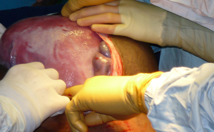 Umbilical Hernia After C Section (Cesarean Delivery)