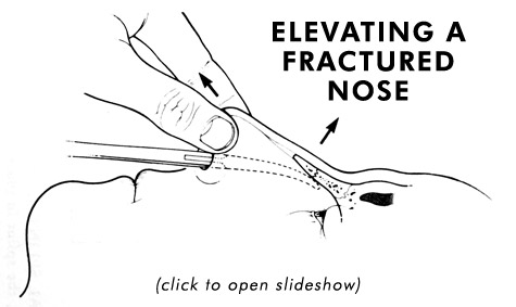 Slideshow Link - Elevating a Nasal Fracture