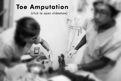 Slideshow Link - Toe Amputation