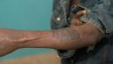 The patient’s arm over a month after the skin graft was done